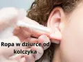 Ropa w dziurce od kolczyka, widoczna podczas czyszczenia ucha wacikiem.