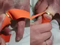 Pomoc w zdjęciu pierścionka z bardzo spuchniętego palca za pomocą pomarańczowej wstążki. Technika ta pomaga zmniejszyć obrzęk.