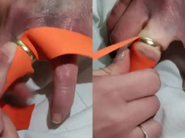 Pomoc w zdjęciu pierścionka z bardzo spuchniętego palca za pomocą pomarańczowej wstążki. Technika ta pomaga zmniejszyć obrzęk.